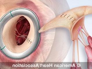 Heart valve repair illustration